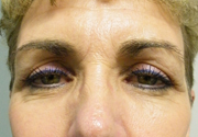 Patient # 21864 After Photo # 2