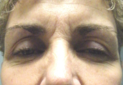 Patient # 21864 Before Photo # 1