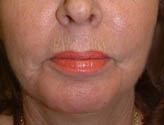 Patient # 13269 After Photo # 2