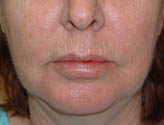 Patient # 13269 Before Photo # 1