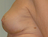 Patient # 22119 After Photo # 4