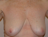 Patient # 22119 Before Photo # 1