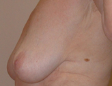 Patient # 22119 Before Photo # 3