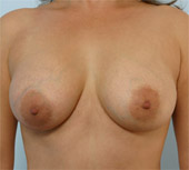 Patient # 31762 After Photo # 2