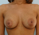Patient # 35039 After Photo # 2