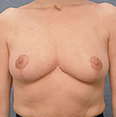 Patient # 18459 After Photo # 2