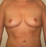 Patient # 41019 After Photo # 2