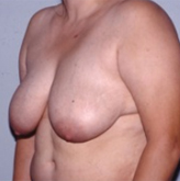 Patient # 41019 Before Photo # 3