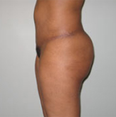 Patient # 47728 After Photo # 4