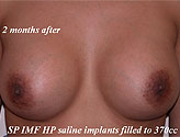 Patient # 98015 After Photo # 2
