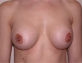Patient # 69179 After Photo # 2