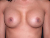 Patient # 55570 After Photo # 2