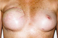 Patient # 79390 After Photo # 2