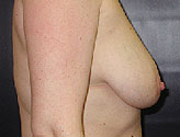 Patient # 86202 Before Photo # 3