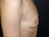 Patient # 37708 Before Photo # 3