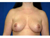 Patient # 44366 After Photo # 2
