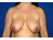 Patient # 44366 Before Photo # 1