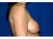 Patient # 44366 Before Photo # 5
