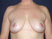 Patient # 45013 After Photo # 2
