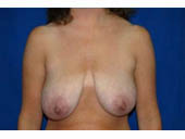 Patient # 35010 Before Photo # 1