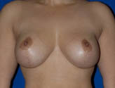 Patient # 21325 After Photo # 2