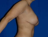 Patient # 21325 After Photo # 6