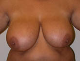 Patient # 21325 Before Photo # 1