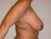 Patient # 21325 Before Photo # 5