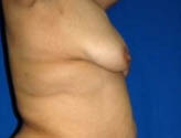 Patient # 65879 Before Photo # 5