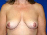 Patient # 34123 After Photo # 2