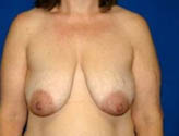 Patient # 34123 Before Photo # 1