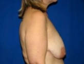 Patient # 34123 Before Photo # 5
