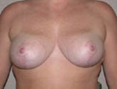 Patient # 29135 After Photo # 2