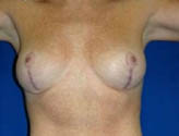 Patient # 73982 After Photo # 2