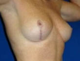 Patient # 73982 After Photo # 4