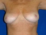 Patient # 73982 Before Photo # 1