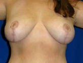Patient # 52696 After Photo # 2