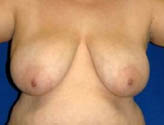 Patient # 52696 Before Photo # 1