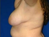 Patient # 52696 Before Photo # 5