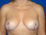 Patient # 28899 After Photo # 2