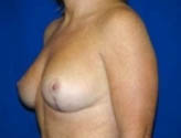 Patient # 28899 After Photo # 4