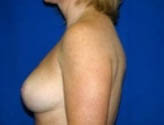 Patient # 28899 After Photo # 6