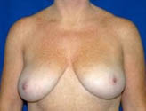 Patient # 28899 Before Photo # 1