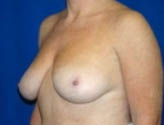 Patient # 28899 Before Photo # 3