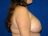 Patient # 78058 Before Photo # 5