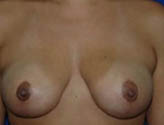 Patient # 13255 After Photo # 2