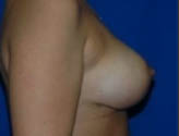 Patient # 13255 After Photo # 6