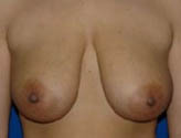 Patient # 13255 Before Photo # 1