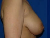 Patient # 13255 Before Photo # 5