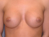 Patient # 36010 After Photo # 2
